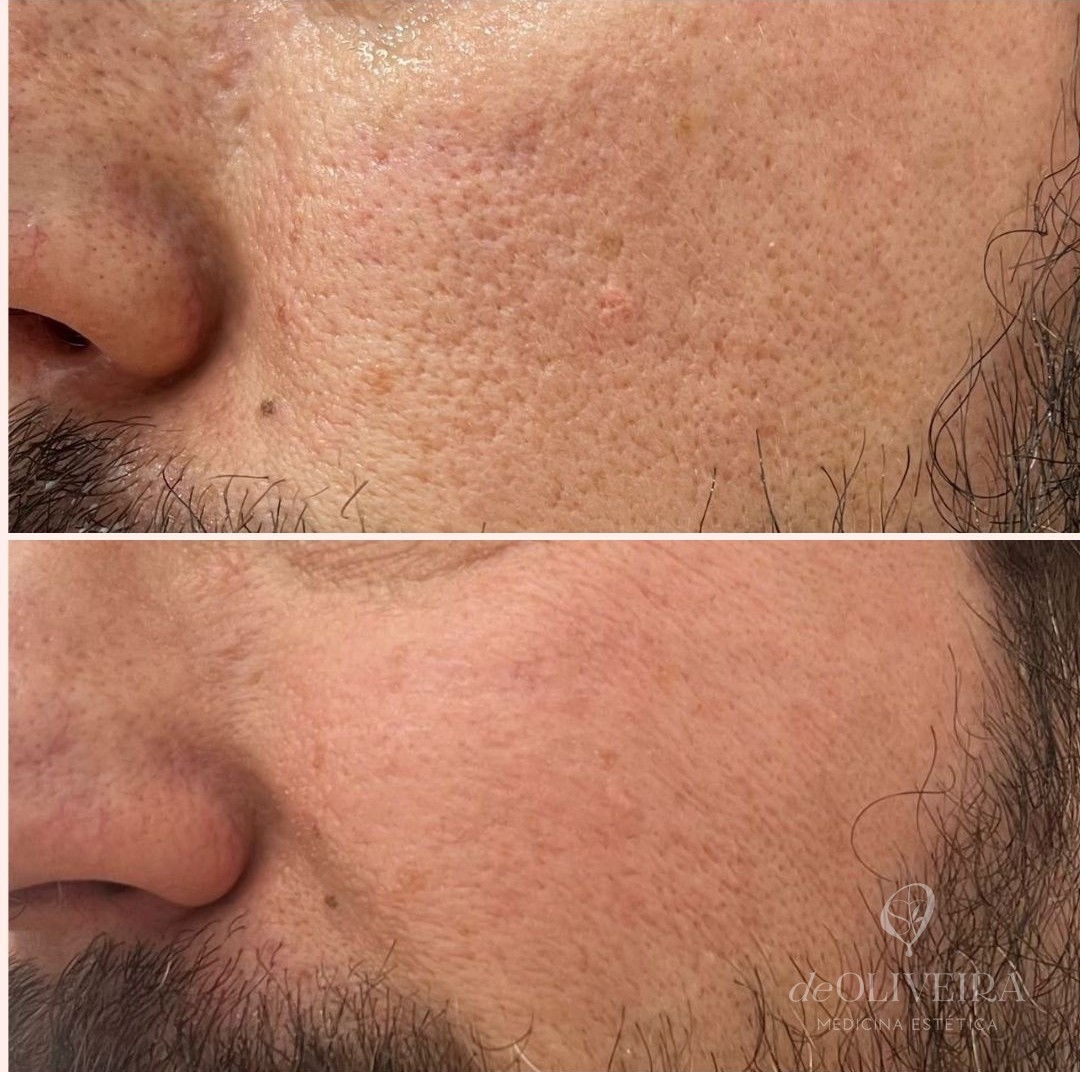 Antes y después en poros y marcas, en deOLIVEIRA | Clinic