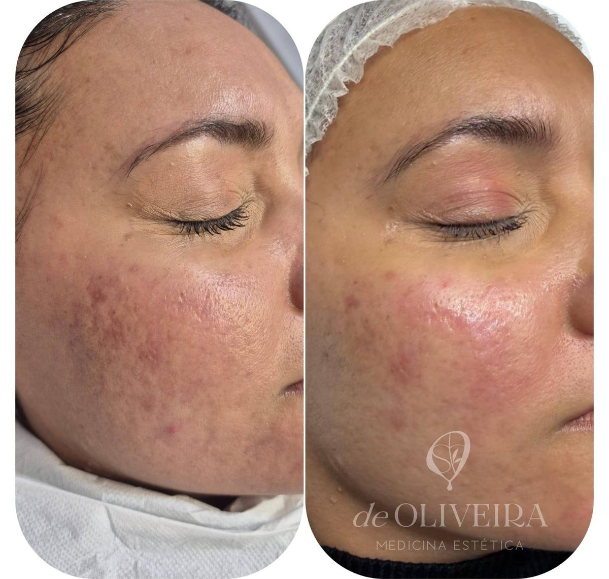 Antes y después de láser CO2 en cicatrices de acné del rostro, en deOLIVEIRA | Clinic
