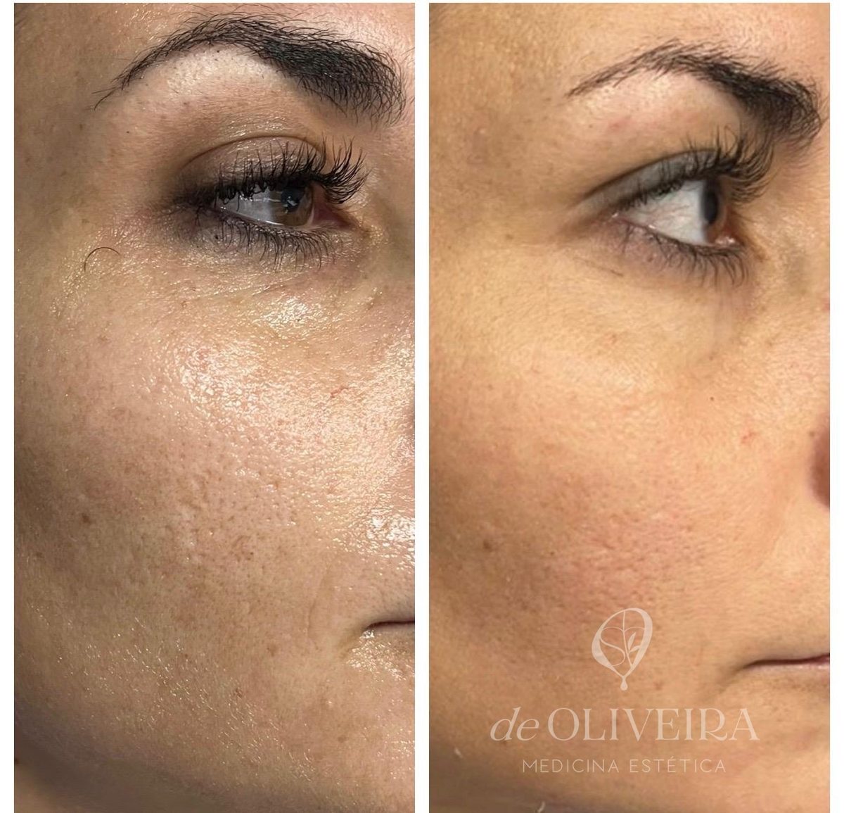 Antes y después en acné (rostro), en deOLIVEIRA | Clinic