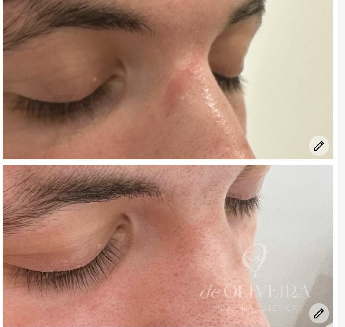 Antes y después en cicatriz en nariz, en deOLIVEIRA | Clinic