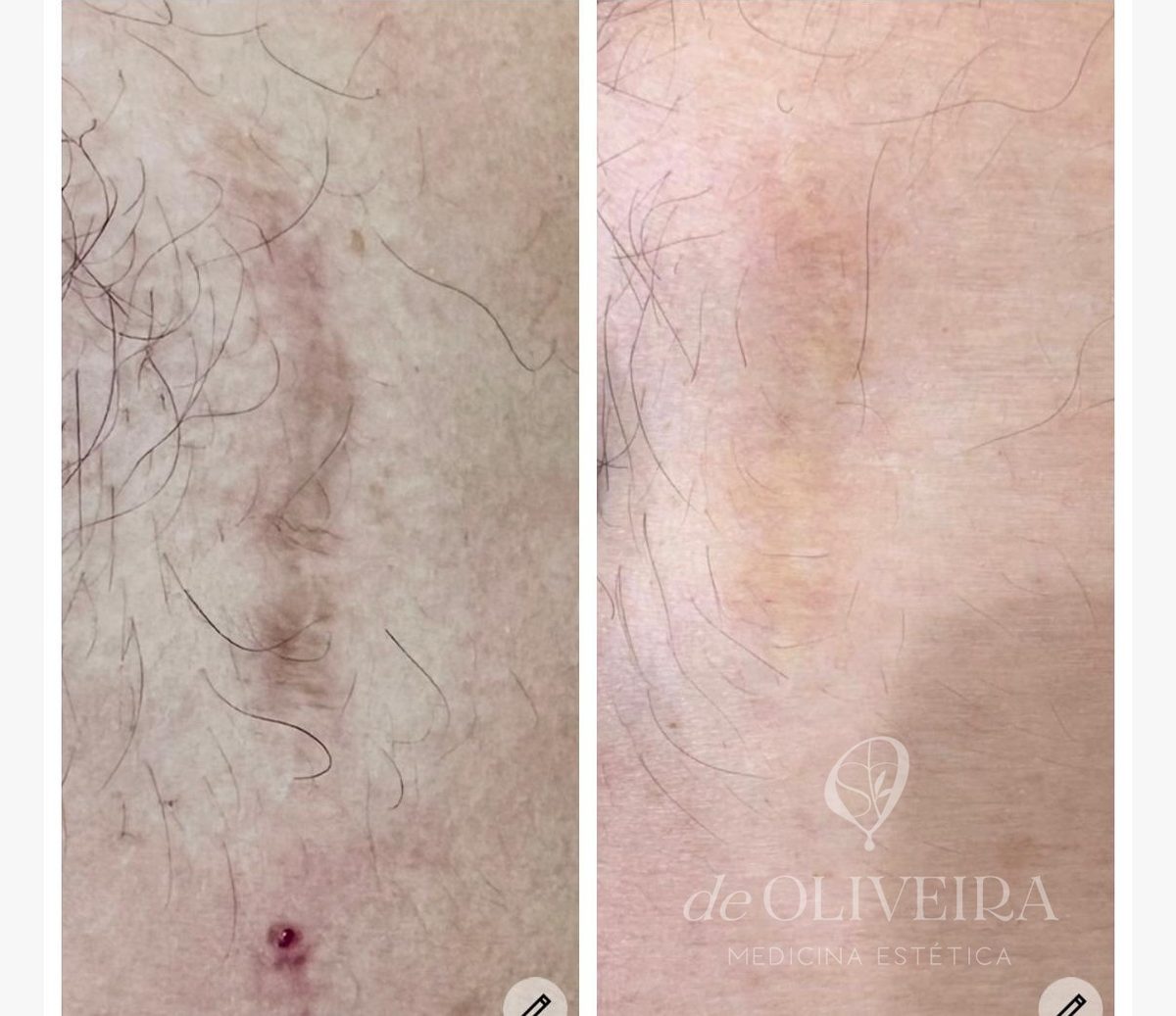 Antes y después en cicatriz (pierna), en deOLIVEIRA | Clinic