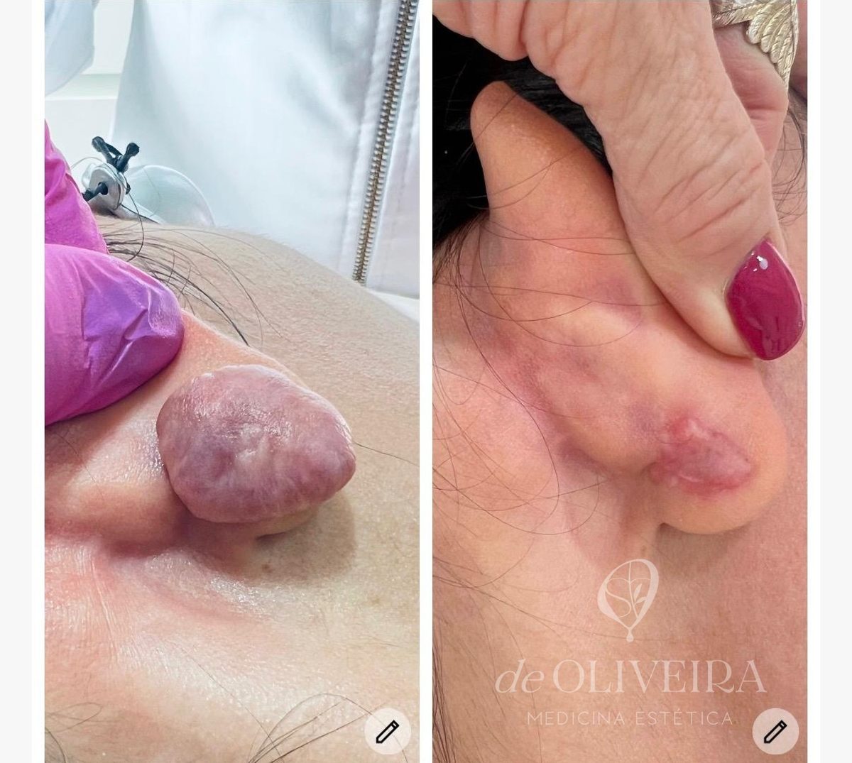 Antes y después en queloide, en deOLIVEIRA | Clinic