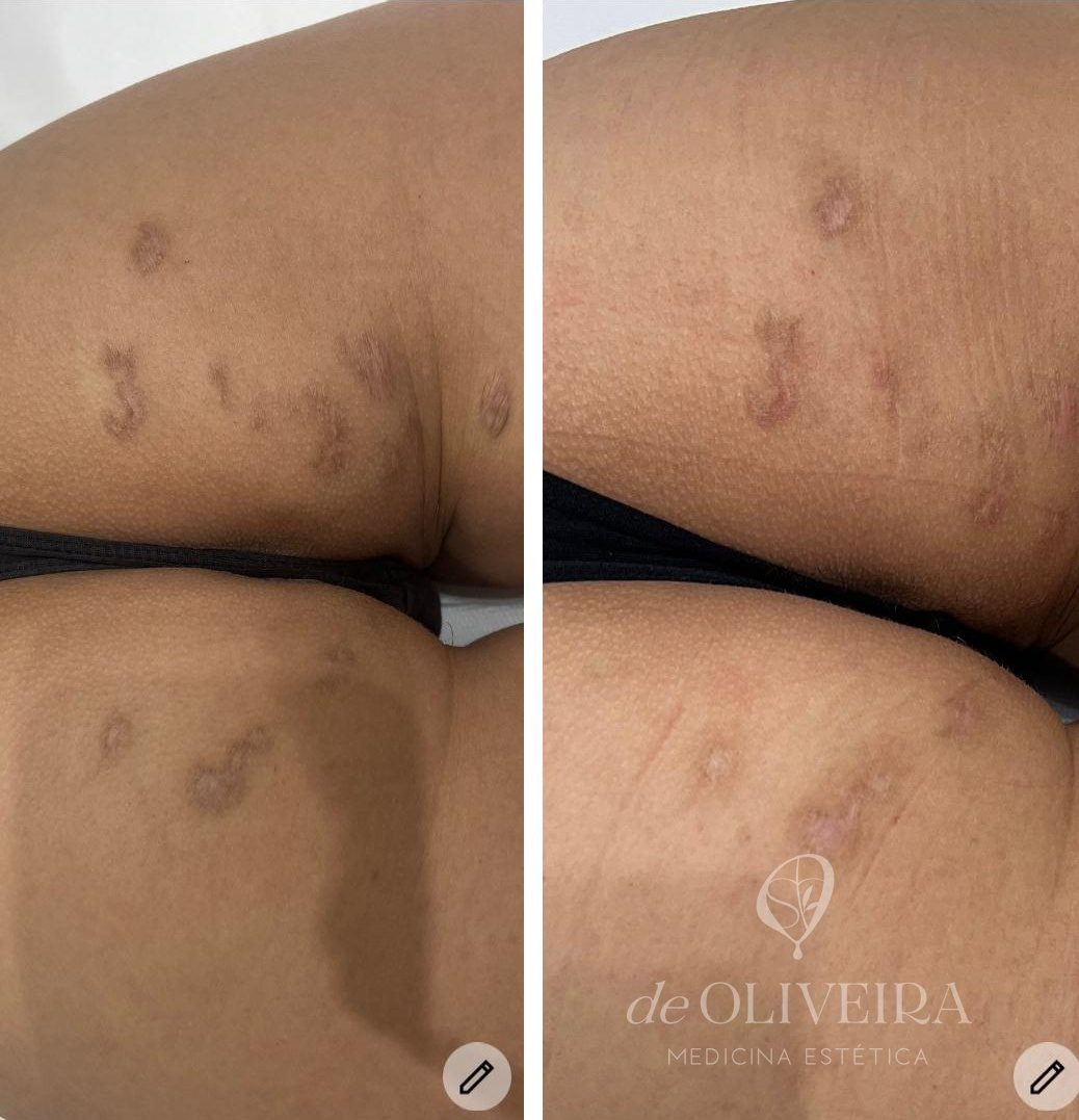 Antes y después en cicatriz quirúrgica, en deOLIVEIRA | Clinic