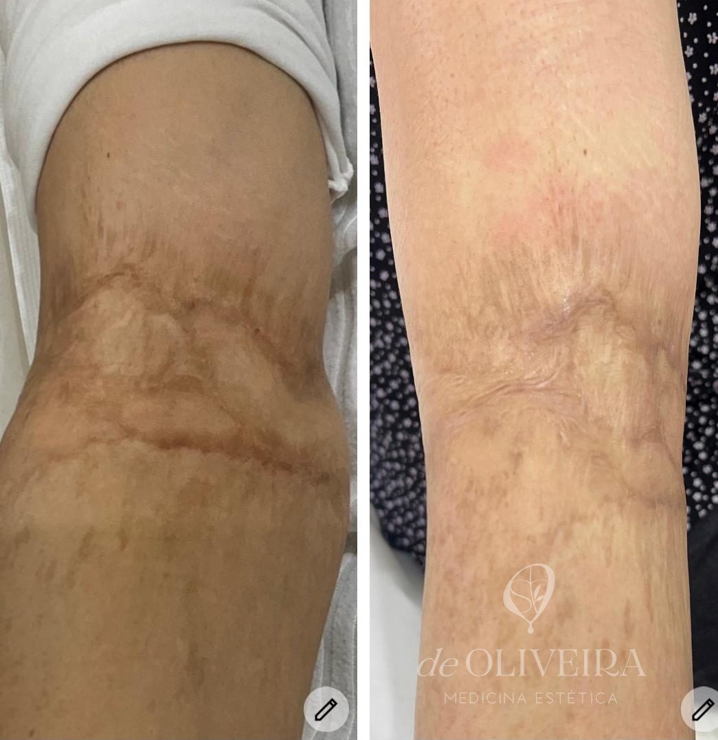 Antes y después de láser CO2 en una cicatriz de rodilla, en deOLIVEIRA | Clinic