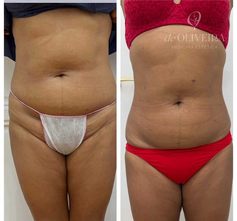 Antes y después en abdomen, en deOLIVEIRA | Clinic