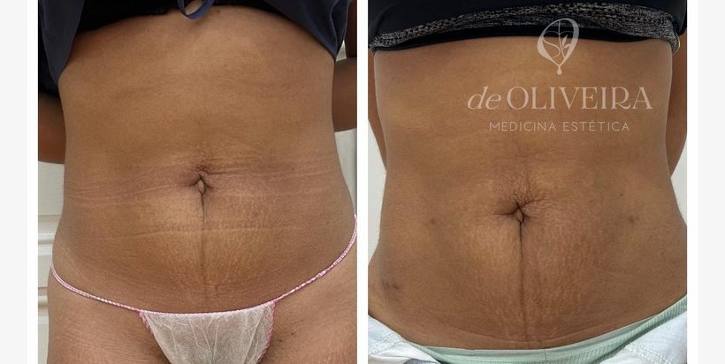 Antes y después en abdomen, en deOLIVEIRA | Clinic
