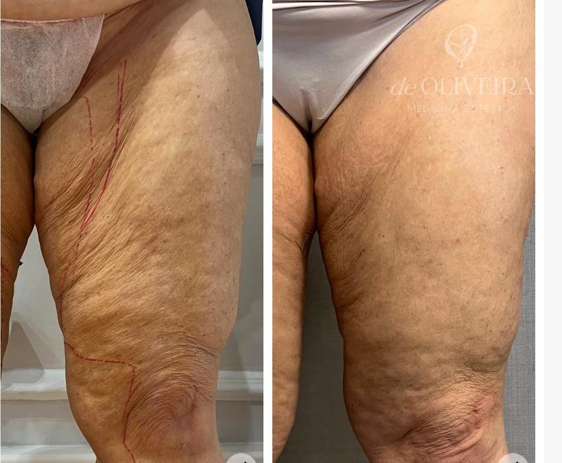 Antes y después en cartucheras, en deOLIVEIRA | Clinic