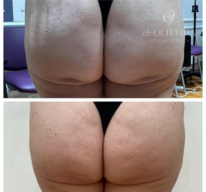 Antes y después en glúteos, en deOLIVEIRA | Clinic