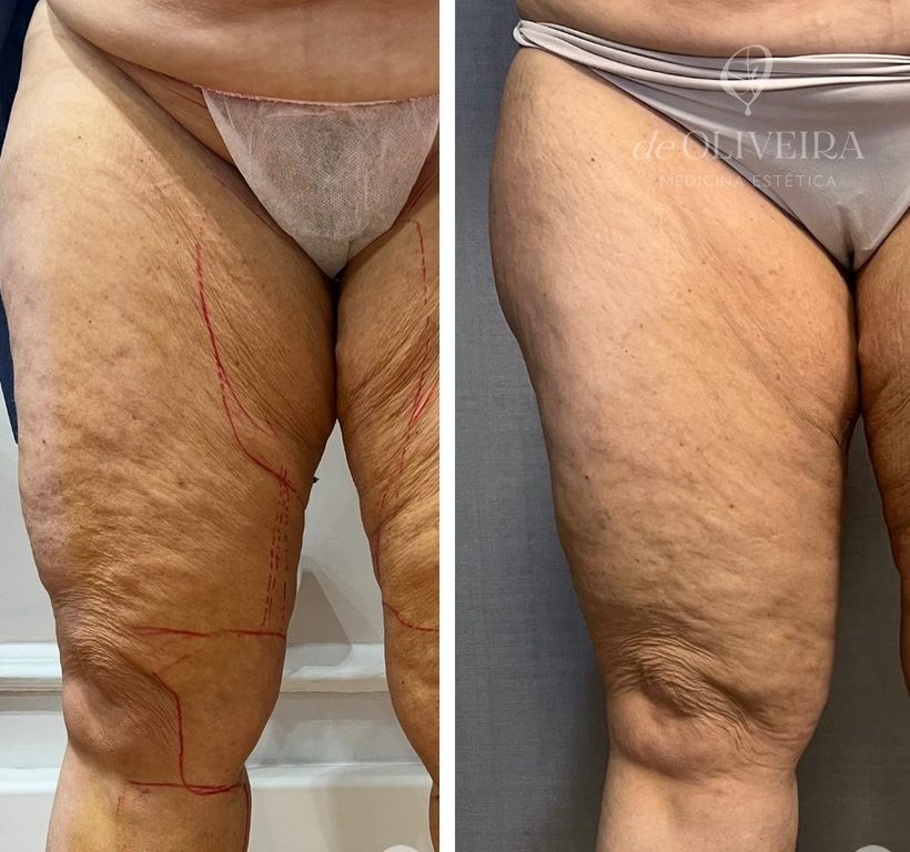 Antes y después en muslos, en deOLIVEIRA | Clinic