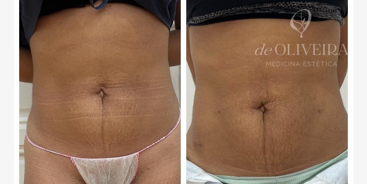 Antes y después de lipoláser (Smartlipo) en abdomen, en deOLIVEIRA | Clinic