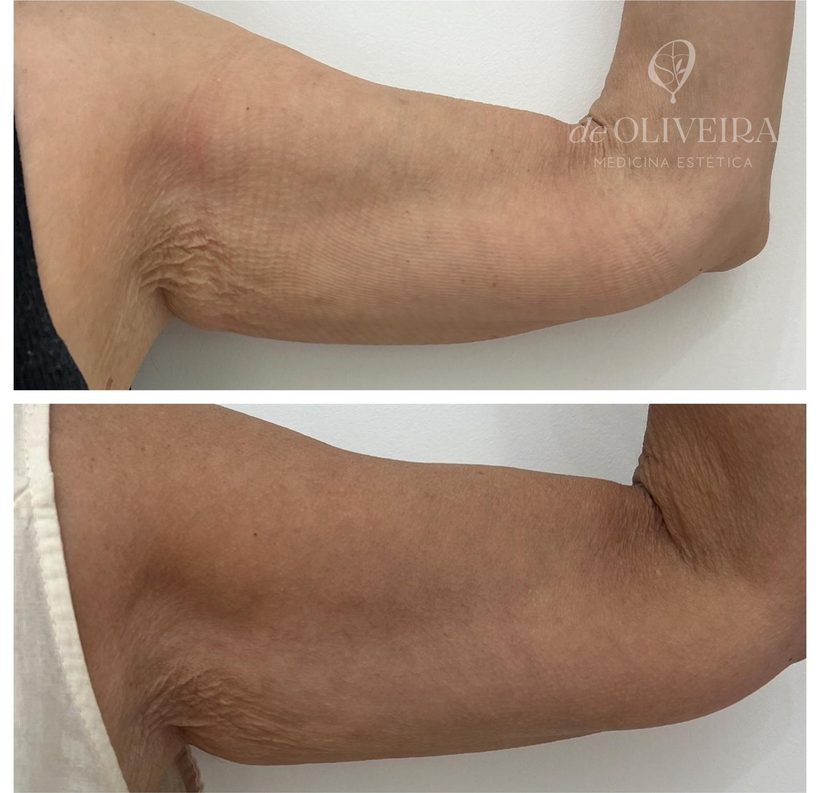Antes y después en brazos, en deOLIVEIRA | Clinic
