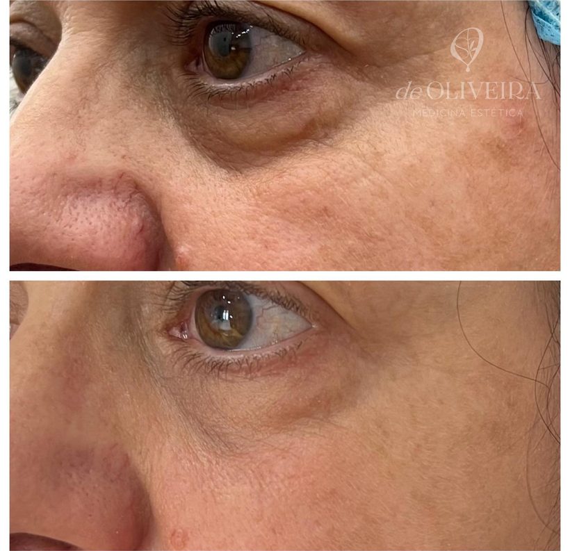 Antes y después en ojeras, en deOLIVEIRA | Clinic
