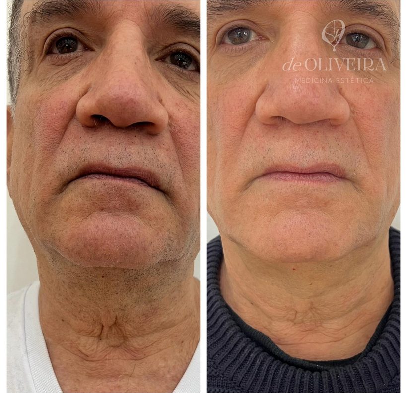Antes y después en papada y cuello, en deOLIVEIRA | Clinic