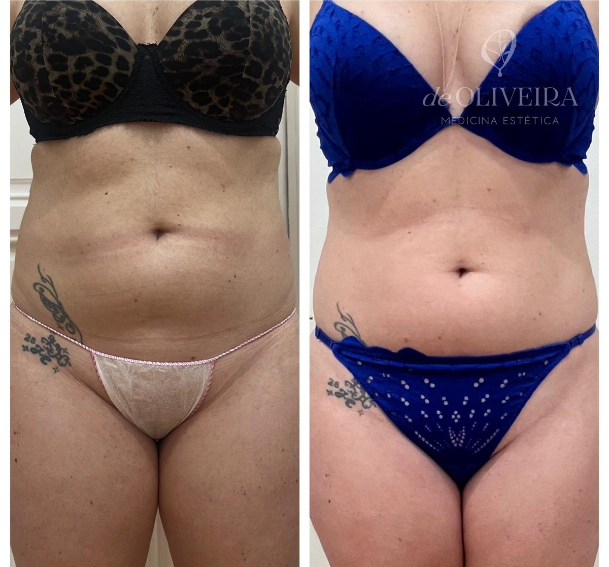 Antes y después de lipoláser (Smartlipo) en abdomen y cintura, en deOLIVEIRA | Clinic